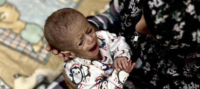 全球震惊：加沙饥饿婴儿照片曝光营养不良、面部紧缩犹如外星人(图1)