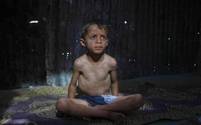 全球震惊：加沙饥饿婴儿照片曝光营养不良、面部紧缩犹如外星人(图2)